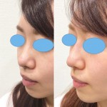 鼻＆あごヒアルロン酸のセットは、プラス３万円でお得です！