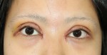 術後は、こんなに悪くなるの？？他院眼瞼下垂修正の場合。