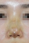 鼻尖形成術（団子鼻手術）は、術後に腫れない？？！