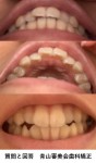 昔20年ほど前に歯列矯正　だんだんとずれて上の前歯のズレ　抜歯なしで前歯4本の部分矯正が可能？