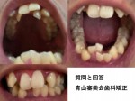 出っ歯で下の歯もがたがたな状態ですが、部分矯正かマウスピース(インビザライン)矯正もできますか？