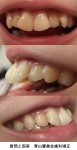 前歯の大きさがコンプレックス、歯列矯正で治りますか？セラミックではないと厳しい？どのような方法が？