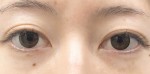 目の下の皮膚の状態が涙袋ヒアルロン酸を左右します。