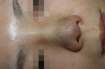 鼻尖形成術（団子鼻手術）は、どれくらい腫れる？？