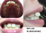 前歯が大きく隣の歯が内側にねじれているのを治したい　上顎の部分矯正(裏側)で治る？
