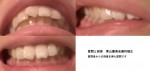 前歯のでこぼこ、出っ歯、上の歯の噛み合わせが深いことが気になり　部分矯正は難しいですか？