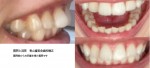 前から見ると歯並びが良く見える　横から見ると出っ歯　裏側矯正の部分矯正と上下矯正とどちらが良い？