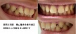 上の前歯の隙間をうめたい  上の歯だけの部分矯正やマウスピース矯正は可能？ やはり全体的な矯正が