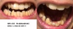 前歯若干の出っ歯、下6本の歯並びが気になり　裏側矯正の部分矯正は可能？お見積も