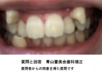 顎が小さくいびきがひどく、歯並びがもひどい　八重歯治療と歯並びを裏側矯正したい