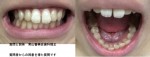 顎がずれ 歯も斜めに生え 左右非対称で見栄えが悪い 口を閉じた時に前歯がでて コンプレックスでストレス