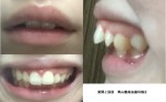 前歯が出ていることが悩み 上の前歯2本が前に出て　上の唇で隠れない　横から見ると口が出て