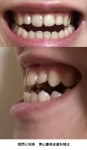前歯が噛み合わず奥歯を噛んだ状態で隙間　治すには外科しかない？費用は