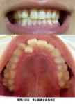 乳歯が突き出た状態で、永久歯が後ろに下がっている状態  歯列矯正ではなくインプラントで治療は？23歳男