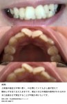 上前歯の歯並びが悪く口を閉じても歯が見えて　親知らずは生えたまま  費用は？ 抜歯をせず矯正は可能？