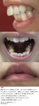 ガチャガチャな歯並び  口を閉じた時に  下唇の下に2つ膨らみ  部分矯正は？