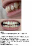 上下のすきっ歯の矯正治療をしたく　上の歯はマウスピース矯正をしましたが、後戻り