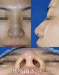 鼻尖形成術（団子鼻手術）術後の腫れは？