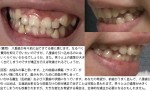 八重歯が年々前に出て　費用を抑えたい　八重歯を引っ込めたい　笑うと上の歯茎が出る　矯正で改善？