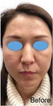 ヒアルロン酸 オールカスタマイズ治療、顔のバランスを整える
