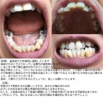 歯並びの悪い箇所が歯周病　歯の矯正後に受け口になる為　手術が必要と言われ