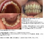 矯正相談　上前歯の出っ張り下の歯並びがガチャガチャ　唇にあたる部分が口内炎