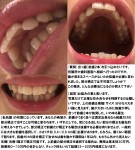 出っ歯（前歯2本）を引っ込めたく　歯科医院で抜歯が必要と言われ　部分矯正は不可能ですか？