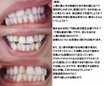 前歯の2本が他の歯に比べて大きく前側に出て　治したい　部分矯正で可能？