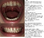 2番目の歯の先天性の欠如で、歯が生えず歯並びが悪く　部分矯正で済むならば