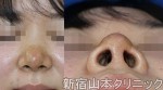 鼻尖形成術（団子鼻手術）で、穴の穴の左右差が酷くなった！！
