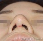 修正手術の鼻柱の傷は、汚く残りますか？