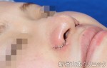 小鼻縮小術の傷