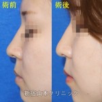 小鼻と鼻先の手術で鼻筋まで変わる？？