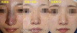 鼻、諸々修正すると、腫れが引きませんか？