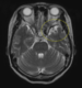 （交通事故相談）左側頭葉の萎縮が分かるMRI