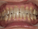 ホワイトニング症例・4（テトラサイクリン歯）