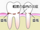歯周病について　その２　〜歯肉炎と歯周炎の違い〜