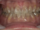 ホワイトニング症例・9（テトラサイクリン歯）