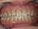 ホワイトニング症例・12（テトラサイクリン歯）