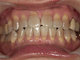 ホワイトニング症例・14（テトラサイクリン歯）