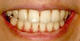 歯の白いシミ（白斑）の原因
