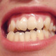 歪み前歯、手術無し矯正だけで治療可能？