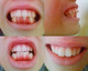 歯並びは全体的に悪い、先に出っ歯を２本