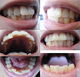 上下前歯のみ(上2本下4本)の歯科矯正を考