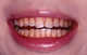 軽度のテトラサイクリン歯を白くする方法