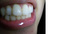 (写真相談)上前歯に小さな白い斑点のような白い部分が