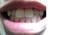 (写真相談)上の前歯（内側から2番目）の2本の歯が内側