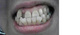上前歯の八重歯、下前歯の乱ぐいと反対口咬