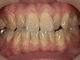 ホワイトニング症例・2（テトラサイクリン歯）