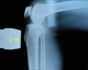 （交通事故相談）膝・足関節のストレスレントゲン撮影